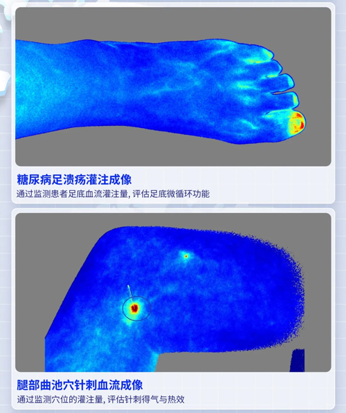 瑞沃德激光散斑血流成像系统获批FDA认证